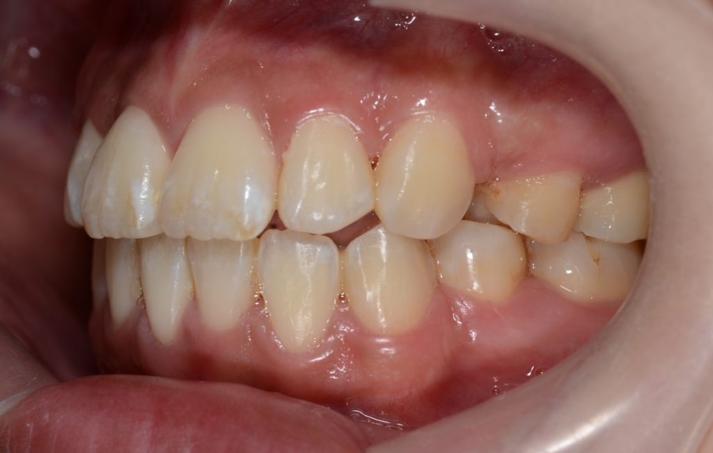 前歯のガタガタを矯正した後の歯並び