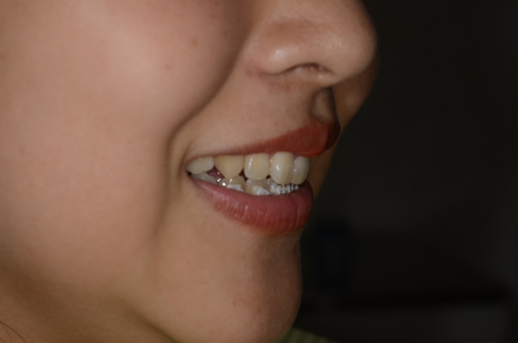 上の歯の裏側に裏側矯正のブラケットが付いた状態で歯の見え方