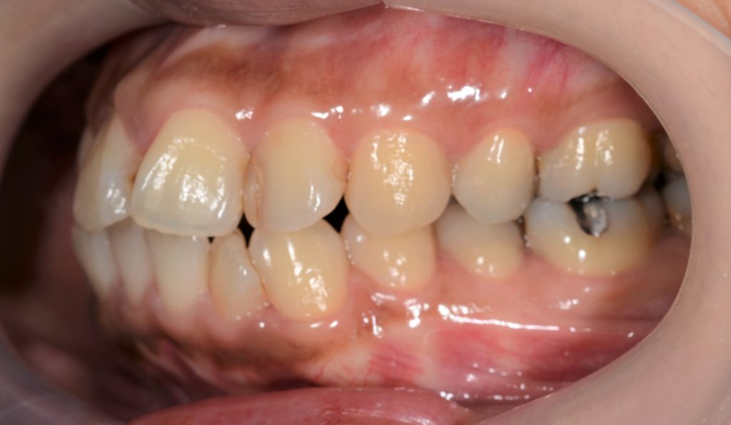 ゴボ口の矯正治療前の歯並び