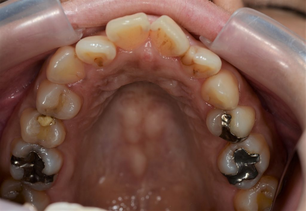 ゴボ口の矯正治療前の歯並び