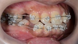 歯の表側に白いブラケット＆銀色のワイヤーで矯正治療
