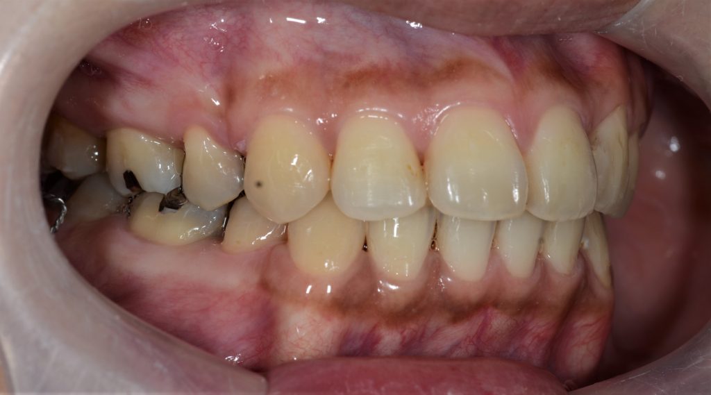 ゴボ口の矯正治療後の歯並び
