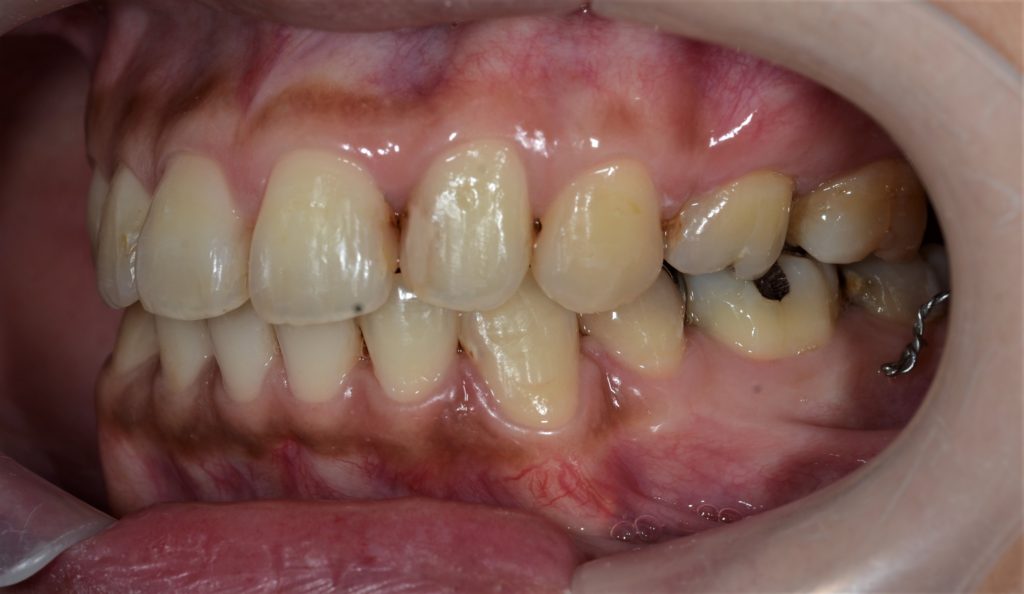 ゴボ口の矯正治療後の歯並び
