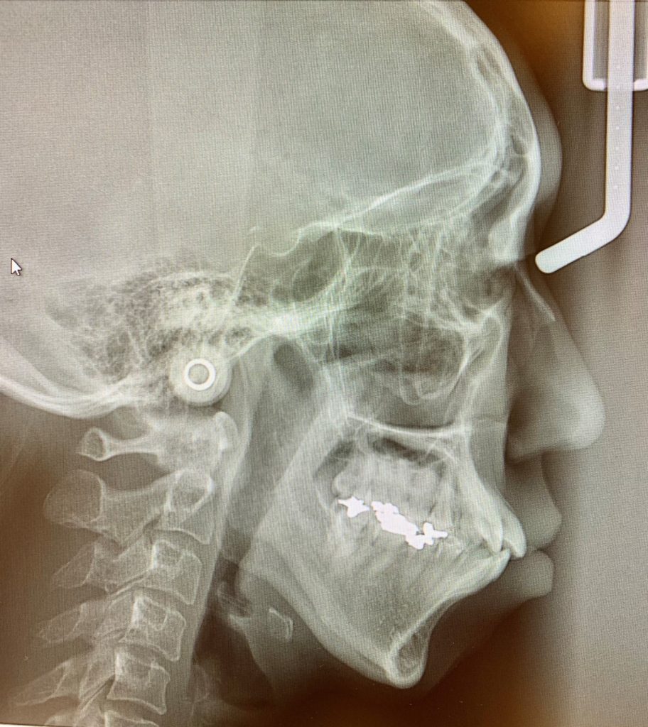 ゴボ口の矯正治療前の頭蓋骨を横から見たレントゲン写真