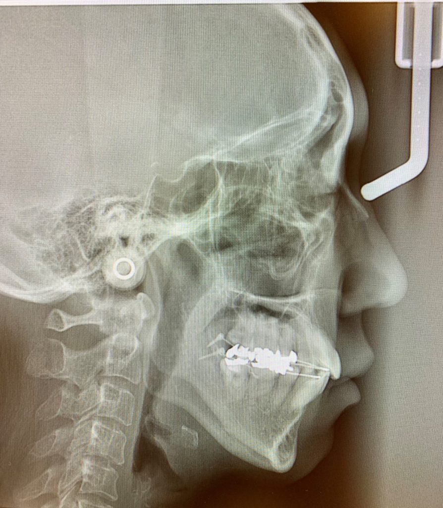 ゴボ口の矯正治療後の頭蓋骨を横から見たレントゲン写真