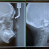 ゴボ口の矯正治療の前後を比較したレントゲン写真