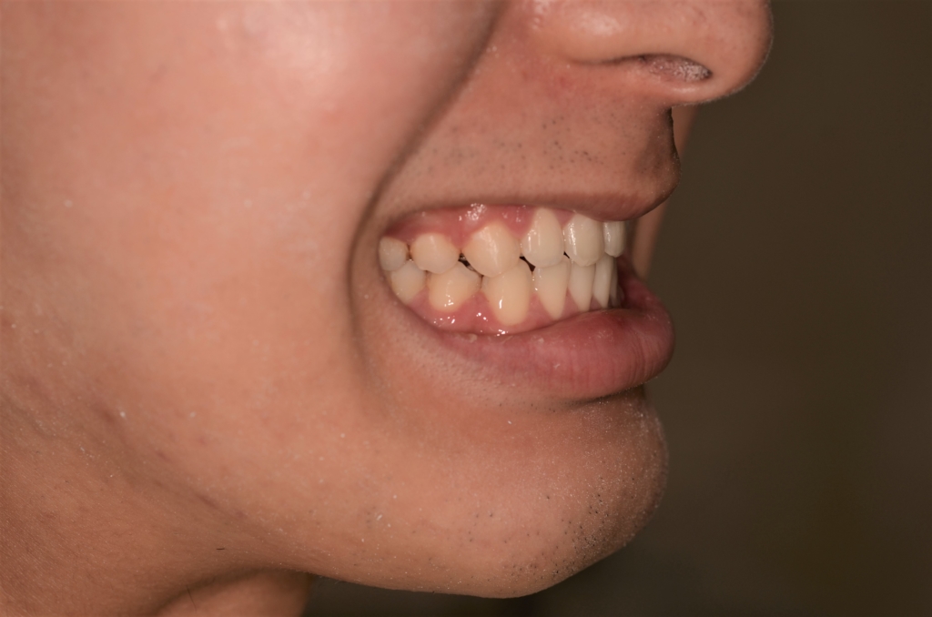 ガミースマイルで口元が出ているのを矯正治療した後の、笑っても歯茎が見えない笑顔の口元