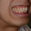 ガミースマイルで口元が出ているのを矯正治療する前の笑うと歯茎が見える笑顔の口元