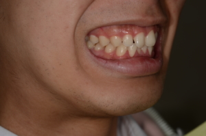 ガミースマイルで口元が出ているのを矯正治療する前の笑うと歯茎が見える笑顔の口元
