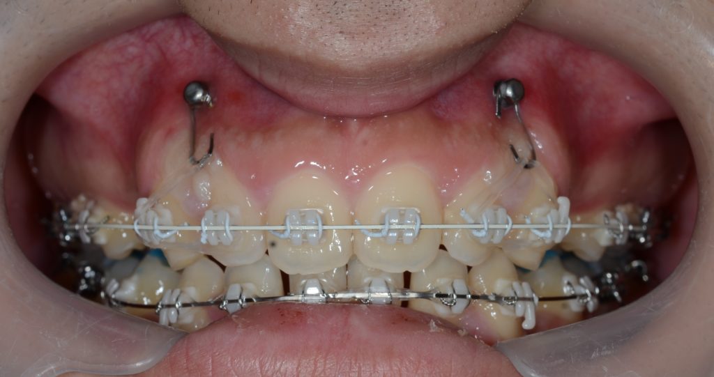歯の表側に白いブラケット＆白色と銀色のワイヤーを用い、アンカースクリューなどを併用した矯正治療