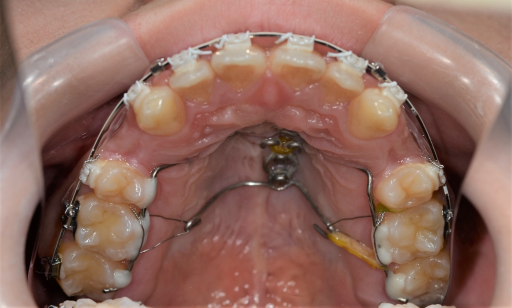 歯の表側に白いブラケット＆白色と銀色のワイヤーを用い、アンカースクリューなどを併用した矯正治療