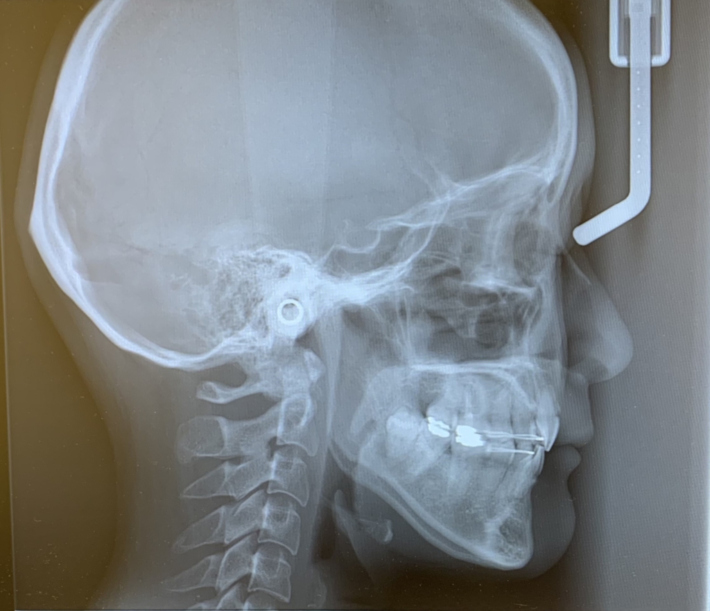ガミースマイルで口ごぼの矯正治療後の頭蓋骨を横から見たレントゲン写真