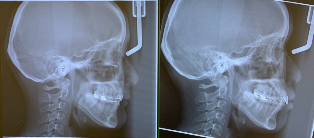 ガミースマイルと口ごぼを矯正した治療前後のレントゲン写真の比較