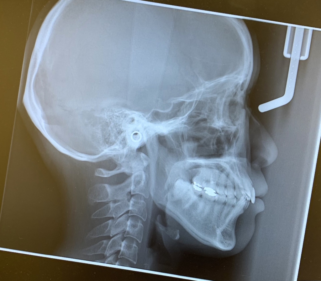 ガミースマイルで口ごぼの矯正治療前の頭蓋骨を横から見たレントゲン写真