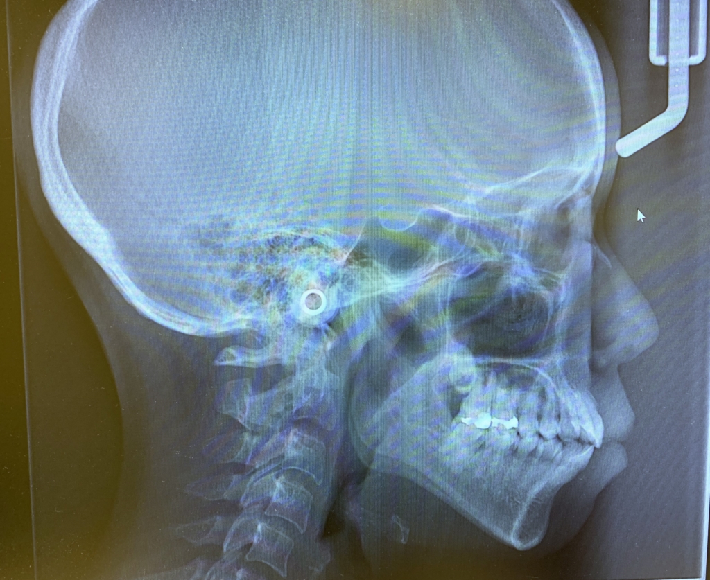 ゴボ口の矯正治療前の頭蓋骨を横から見たレントゲン写真