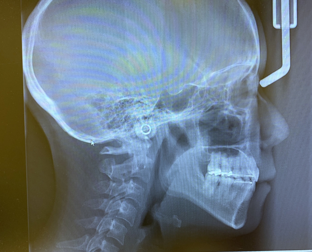 ゴボ口の矯正治療後の頭蓋骨を横から見たレントゲン写真