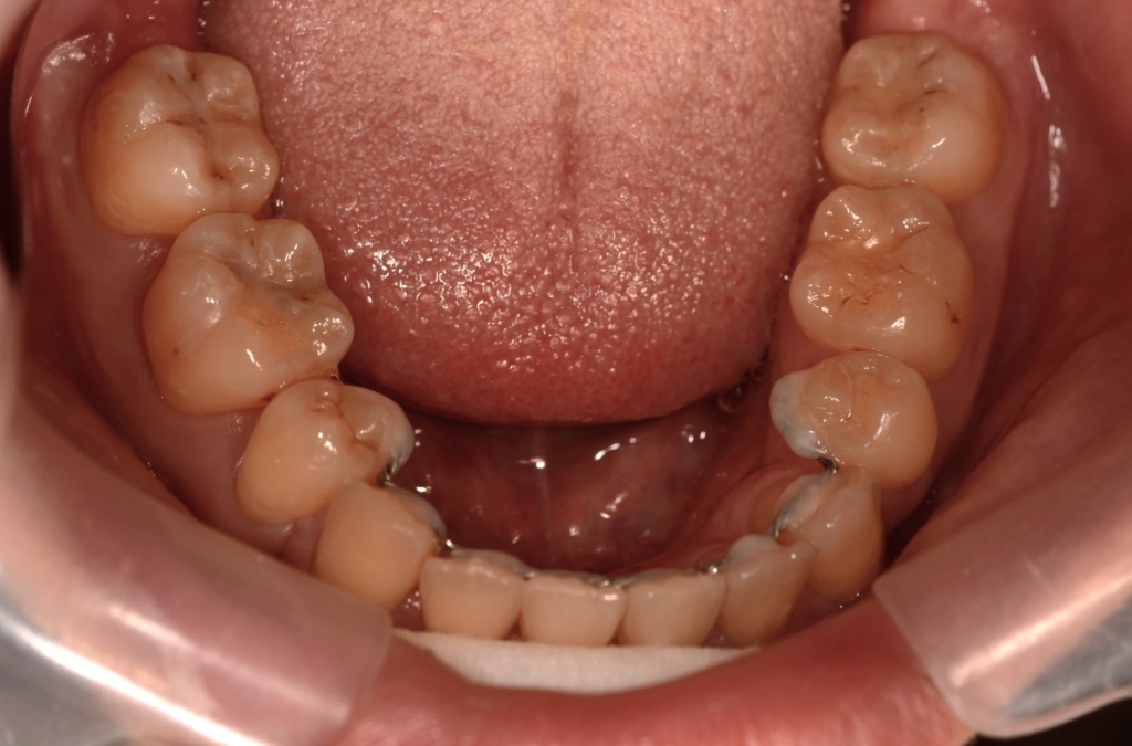 ごぼ口の矯正後の歯並び