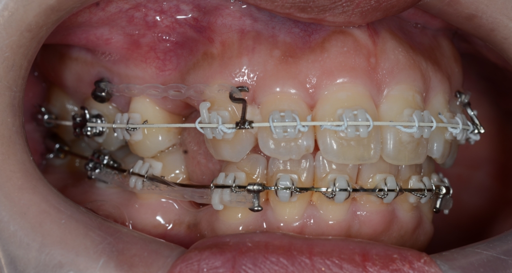 歯の表側に上下とも白いブラケット＆上だけ白いワイヤーで下は銀色のワイヤーで矯正治療