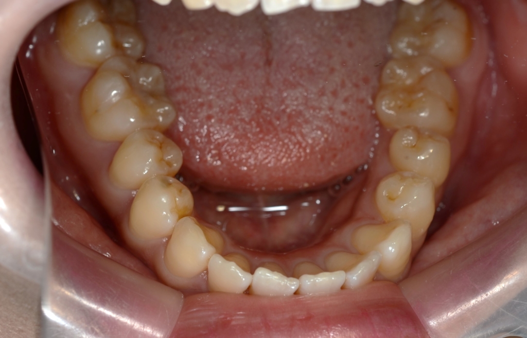 ごぼ口の矯正前の歯並び