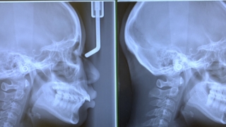 口ゴボの矯正治療の術前と術後のレントゲン写真の比較
