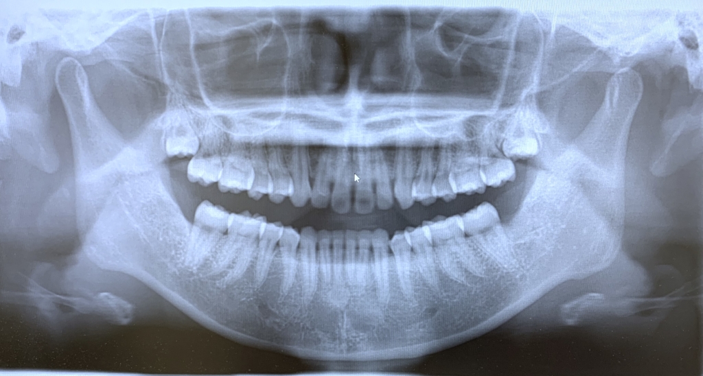 ごぼ口を矯正治療する前の顎全体を写したレントゲン写真