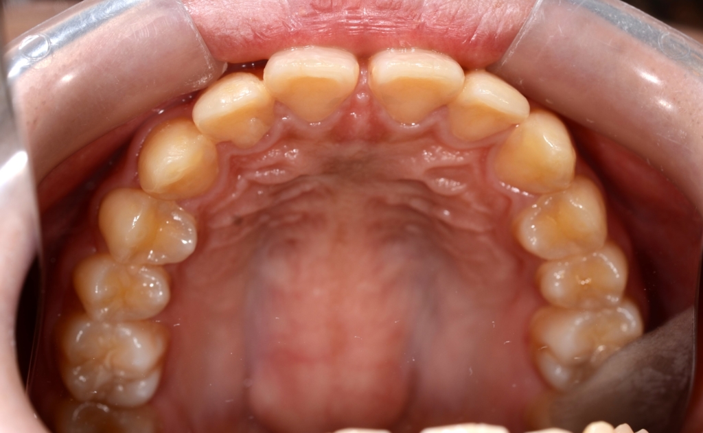 ごぼ口を矯正する前の歯並び