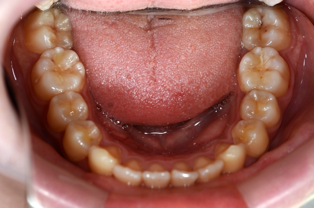 ごぼ口を矯正する前の歯並び