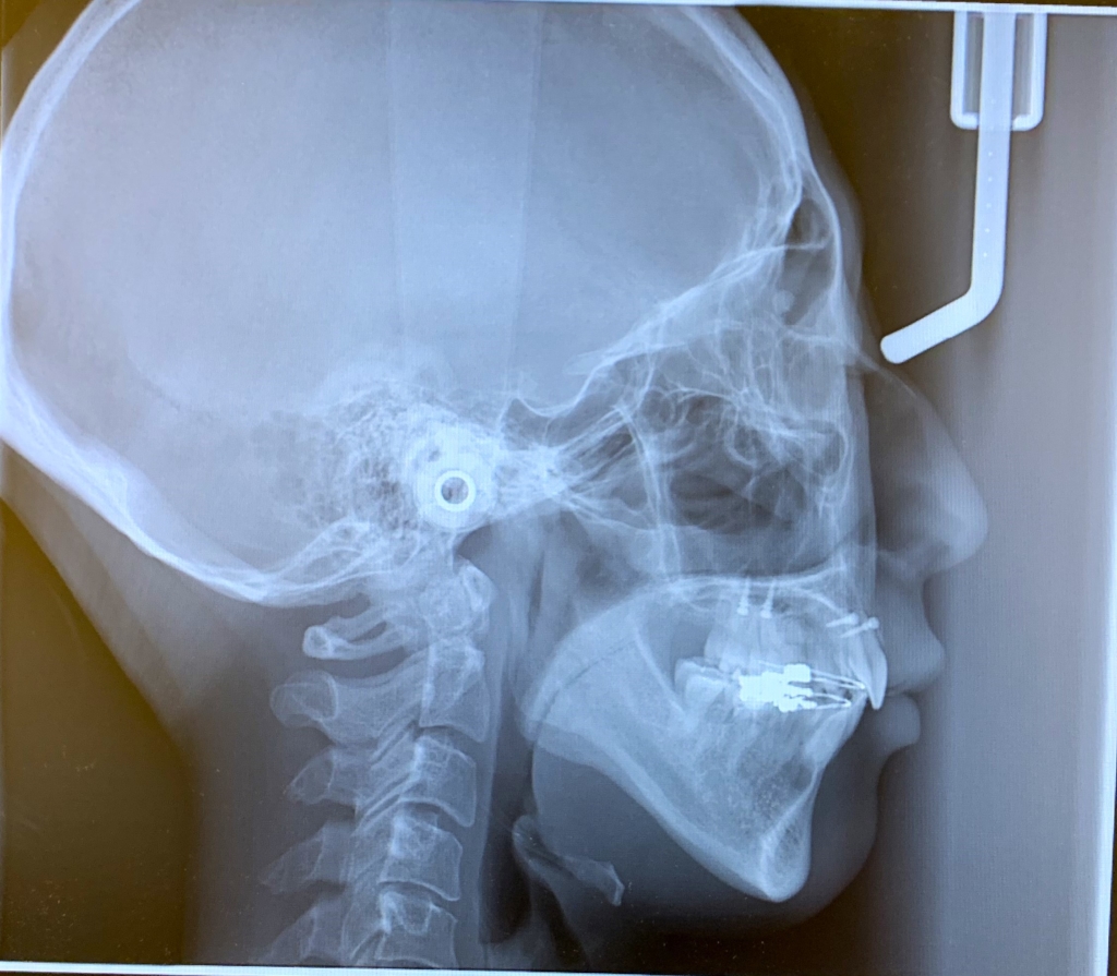 出っ歯で口ごぼの矯正治療後の頭蓋骨を横から見たレントゲン写真