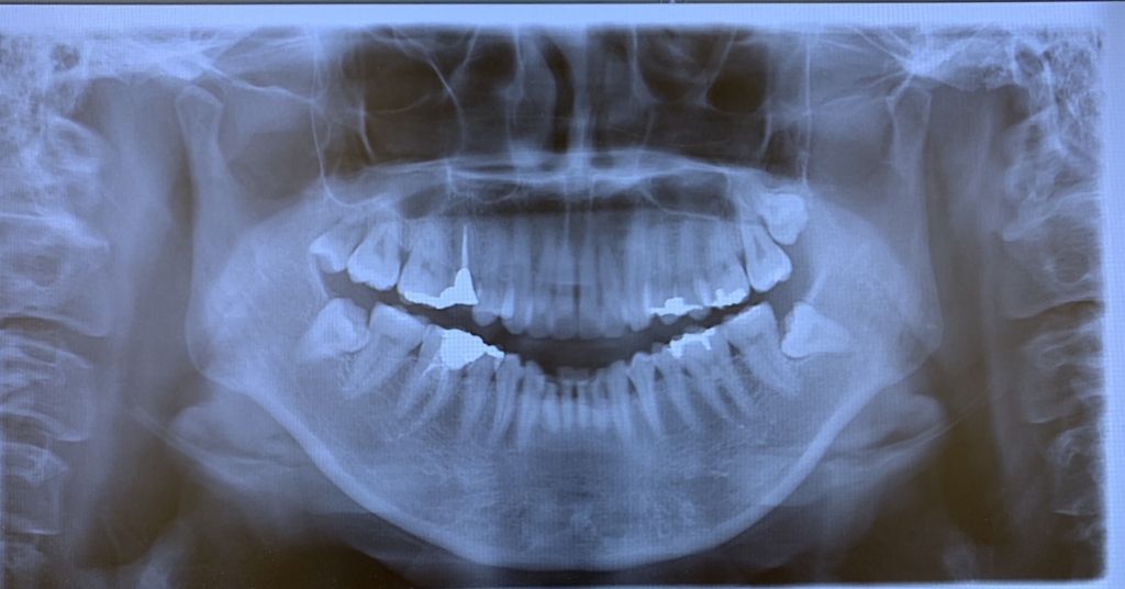 口ごぼの矯正治療前の顎全体を写したレントゲン写真