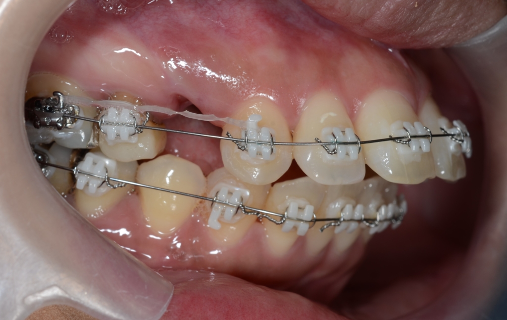 歯の表側に上下とも白いブラケットを付けて銀色のワイヤーで矯正治療