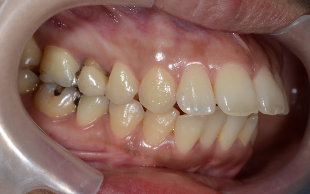 ごぼ口の矯正前の歯並び