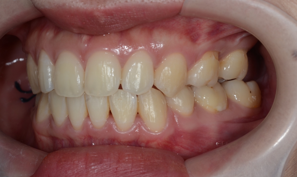 ごぼ口の矯正後の歯並び