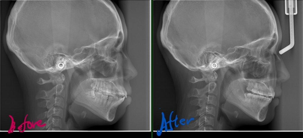 口ゴボを矯正した治療前後のレントゲン写真の比較