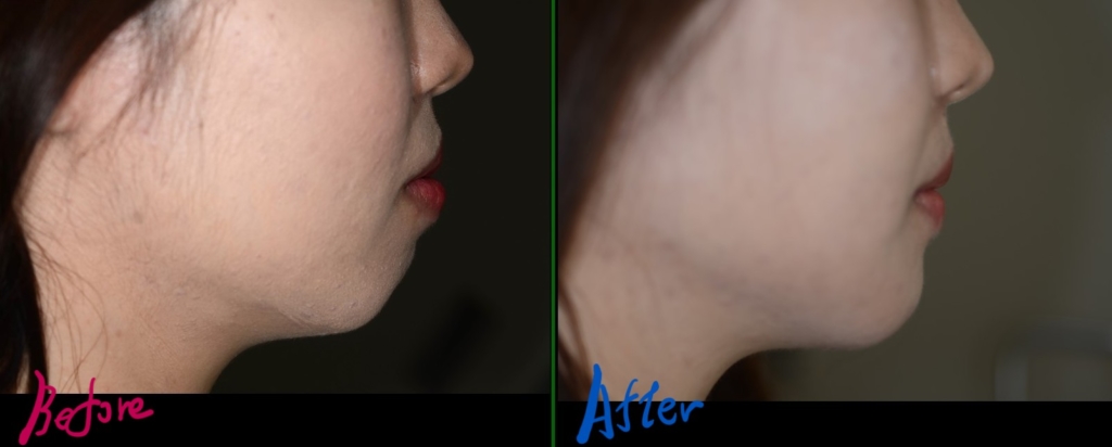 口ゴボを矯正した治療前後の横顔と口元の比較