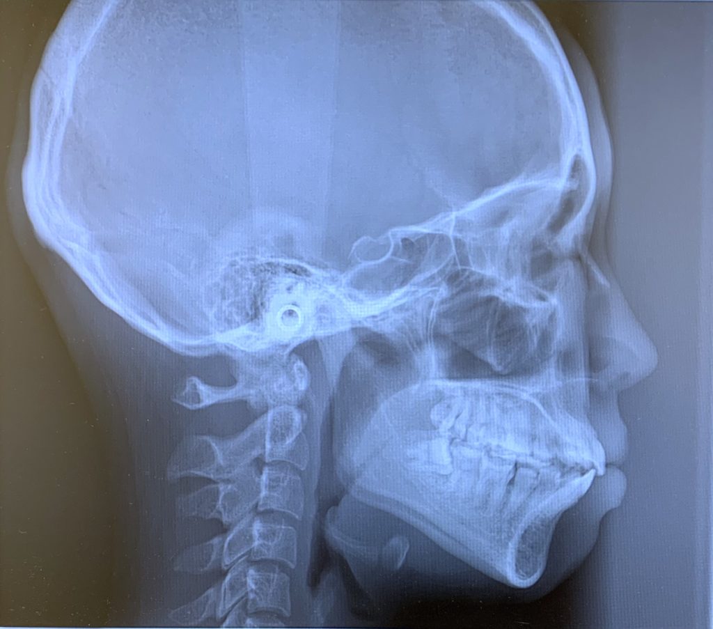 口ごぼの矯正治療前の頭蓋骨を横から見たレントゲン写真