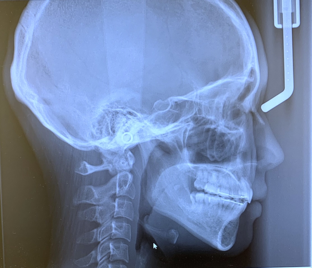 口ごぼの矯正治療後の頭蓋骨を横から見たレントゲン写真