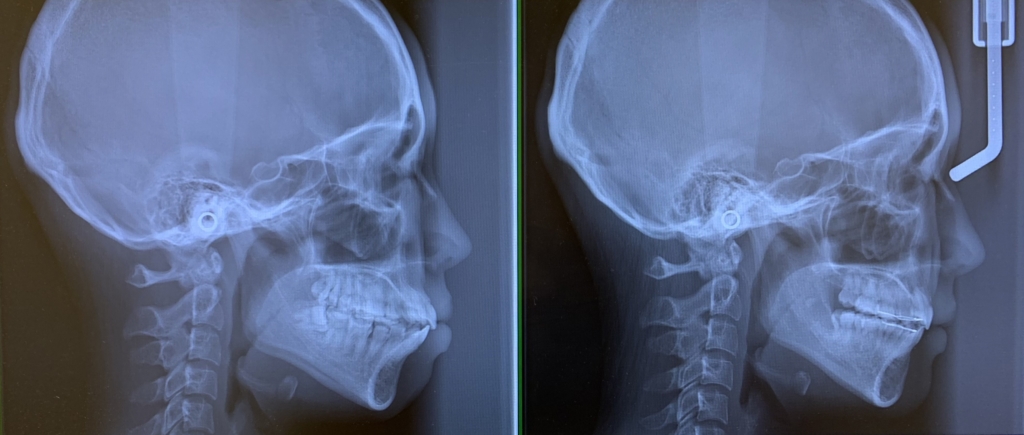 くちゴボの矯正治療前後のレントゲン写真の比較