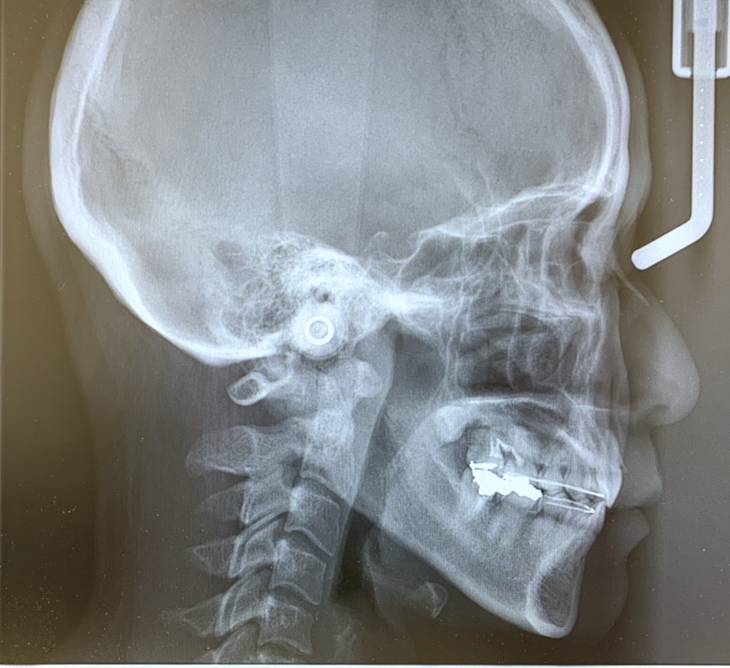 口ゴボを矯正治療した後の頭蓋骨を横から見たレントゲン写真