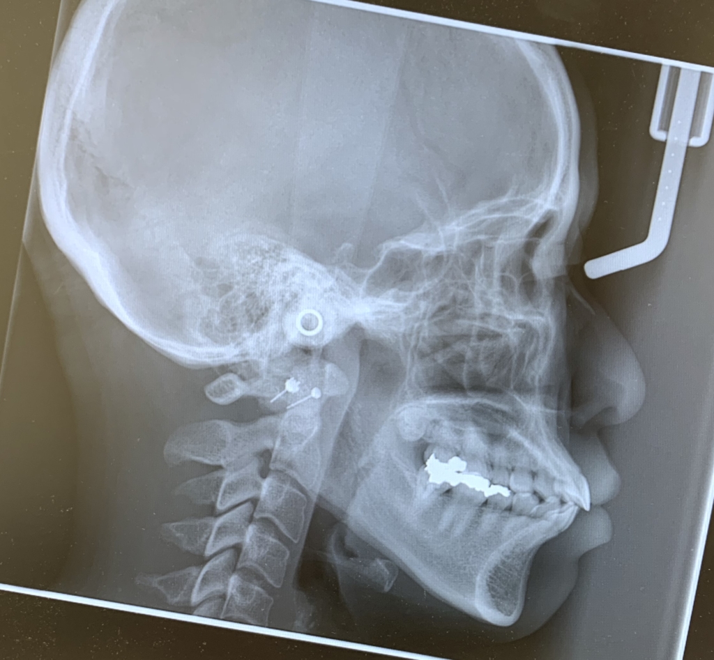 口ゴボを矯正治療する前の頭蓋骨を横から見たレントゲン写真