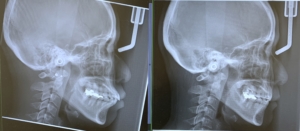 口ゴボの矯正治療の術前と術後のレントゲン写真の比較
