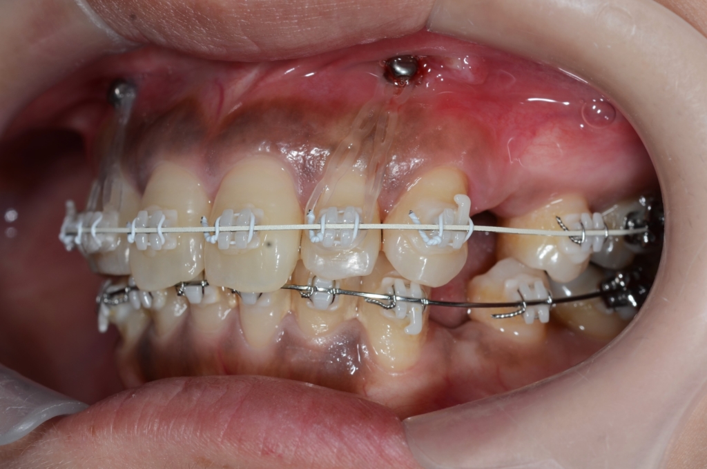 歯の表側に上下とも白いブラケット＆上だけ白いワイヤーで下は銀色のワイヤーで矯正治療