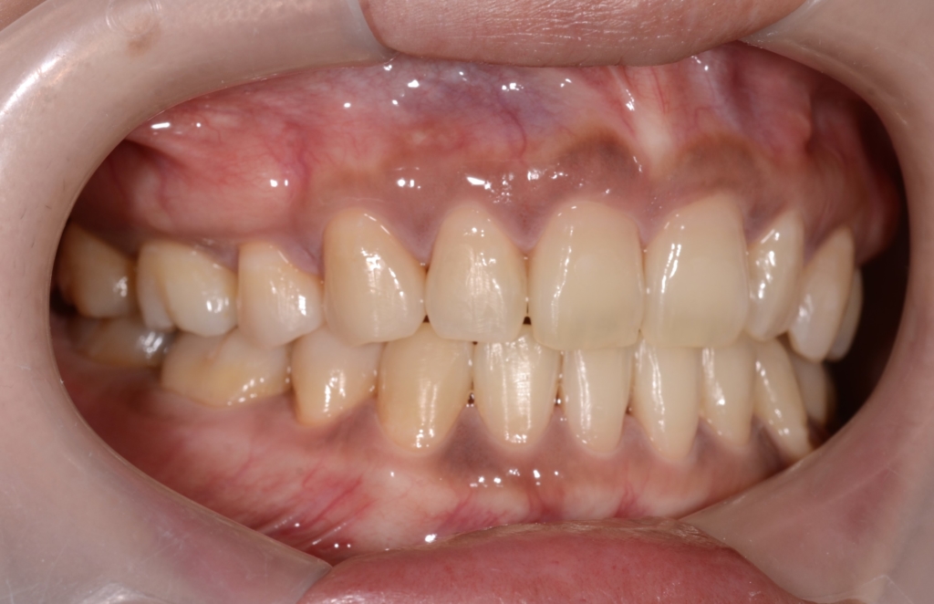 ガミースマイルで口ごぼの矯正治療後の歯並び