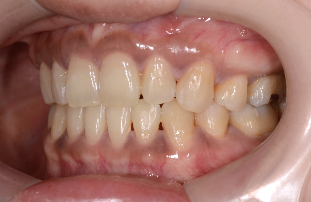 ガミースマイルで口ごぼの矯正治療後の歯並び