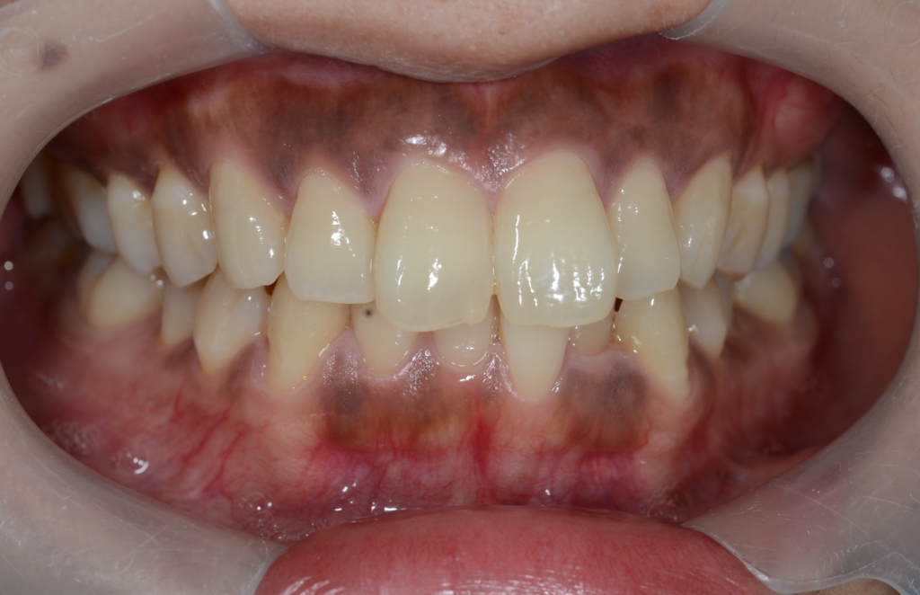 ガミースマイルで口ごぼの矯正治療前の歯並び