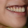 ガミースマイルで口元が出ているのを矯正治療する前の笑うと歯茎が見える口元