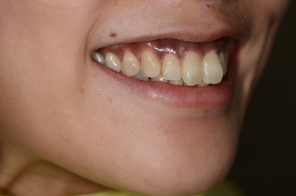 ガミースマイルで口元が出ているのを矯正治療する前の笑うと歯茎が見える口元