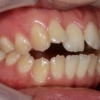 開口を矯正する前の歯並び