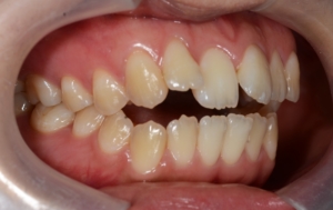 開口を矯正する前の歯並び