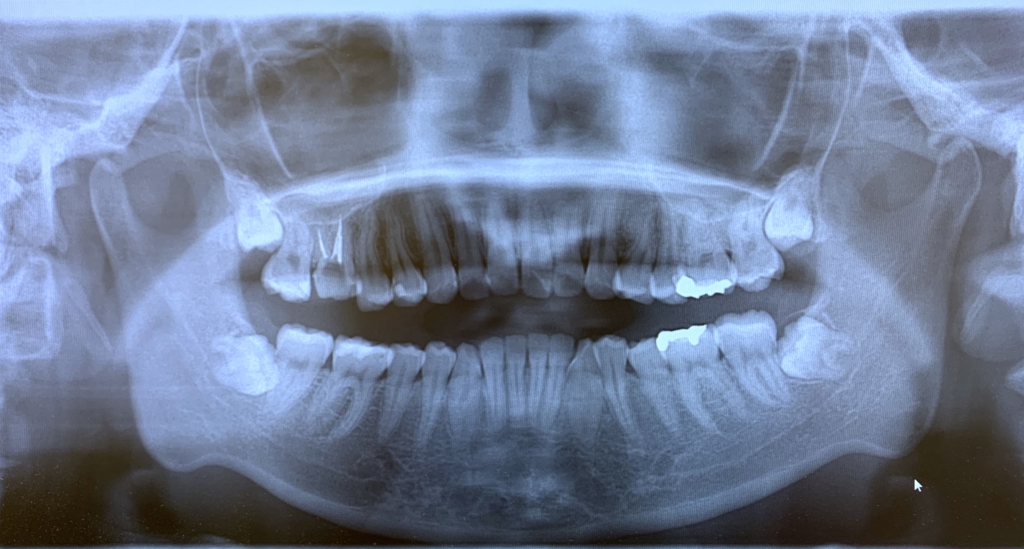 ガミースマイルで口ごぼの矯正治療前の顎全体のレントゲン写真