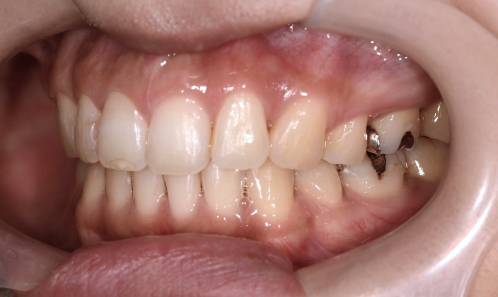 ガミースマイルで口元が出ているのを矯正治療した後の歯並び